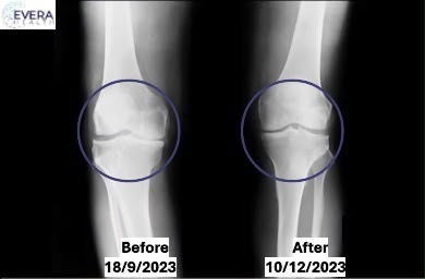 Joint Revive Therapy Procedure